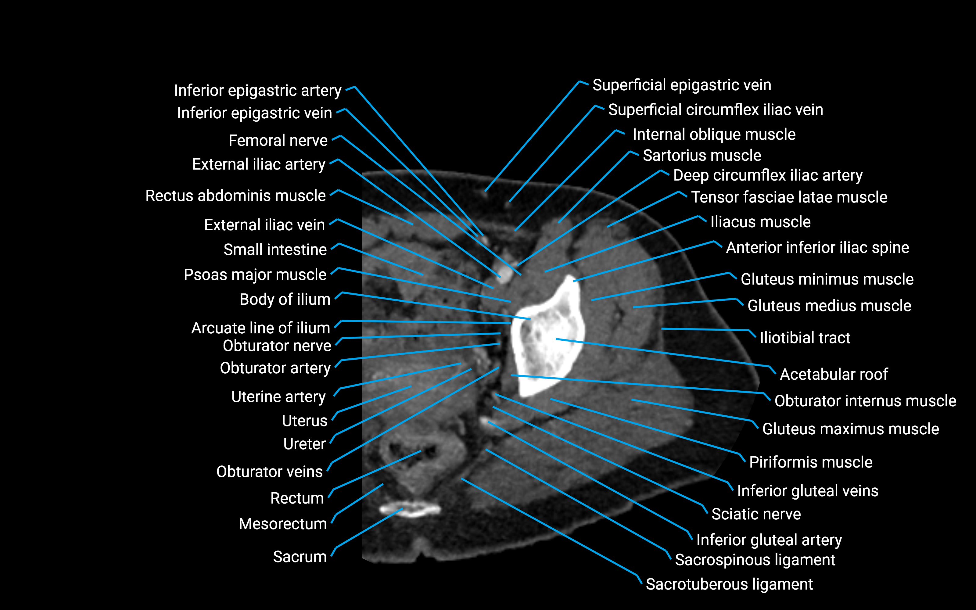 CT Hip axial cross sectional anatomy labelled image 2 (2).png